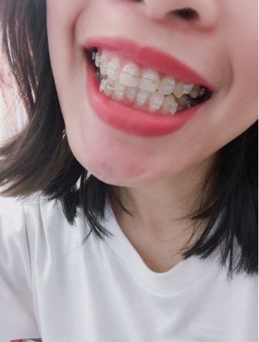 【隐形托槽矫正】【陶瓷矫正】#下单送美白#陶瓷半隐形牙套矫正 ,半