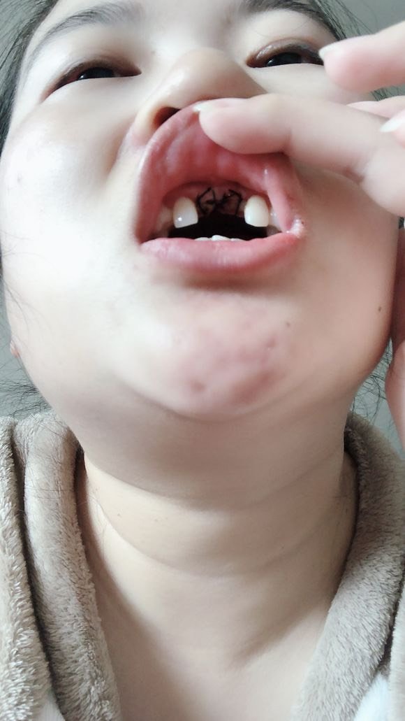 牙不好,96吃啥都没胃口,牙齿坏了好些,有的时候还痛_圈子-新氧美容