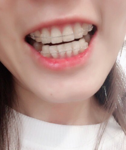 【隐形托槽矫正】【陶瓷矫正】#下单送美白#陶瓷半隐形牙套矫正 ,半