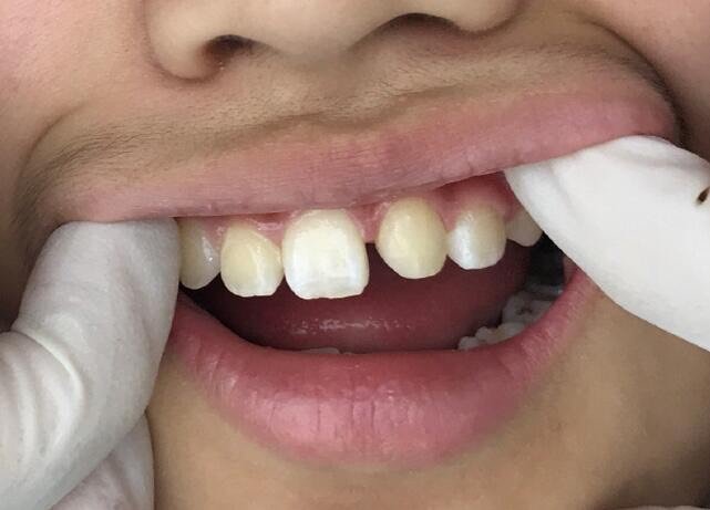 我的牙齿之前有矫正,牙型变好了!但又有1个困扰,就_圈子-新氧美容整形