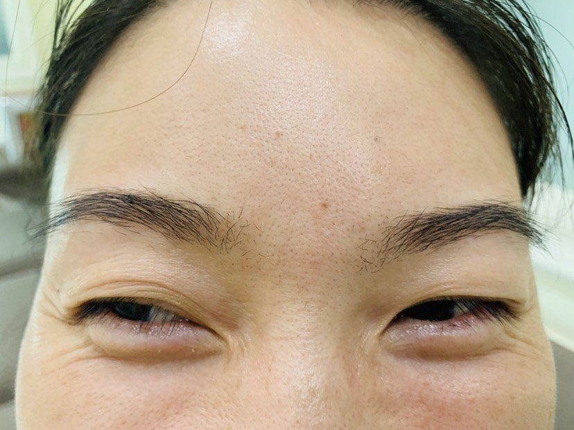 自己做过后效果满意又带着朋友去了朋友的鱼尾纹比较严重希望也能出好