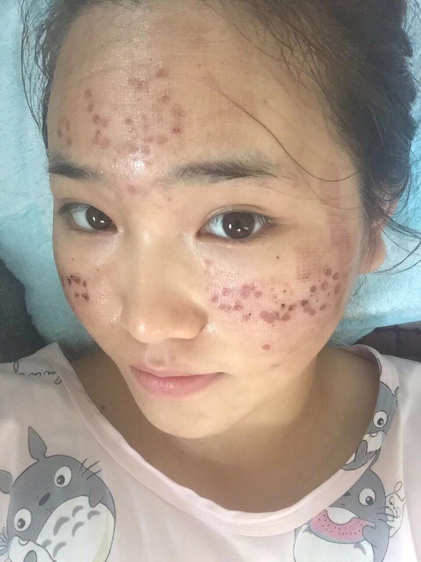 做之前就有了解过什么是点阵激光,据说对改善脸部色素_圈子-新氧美容