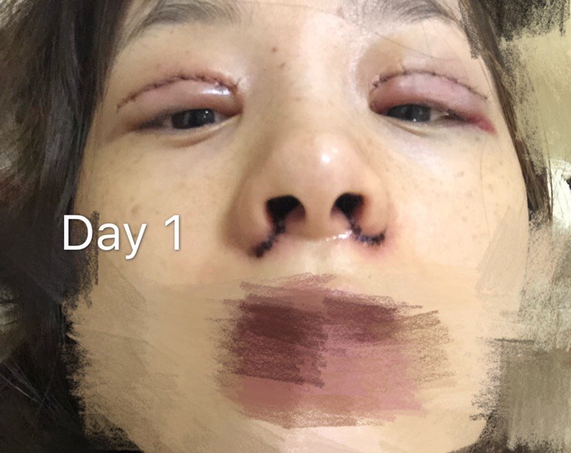 周一上午找郭妤医生做的内切鼻翼缩小和全切双眼皮.