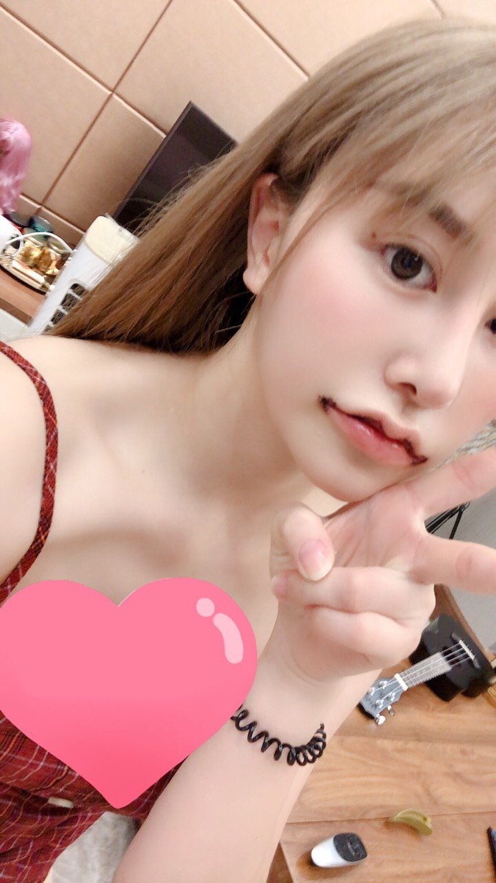 【m唇手术】【微笑唇综合】m唇/唇珠成形/嘴角上扬 厚唇改薄 嘴角上扬