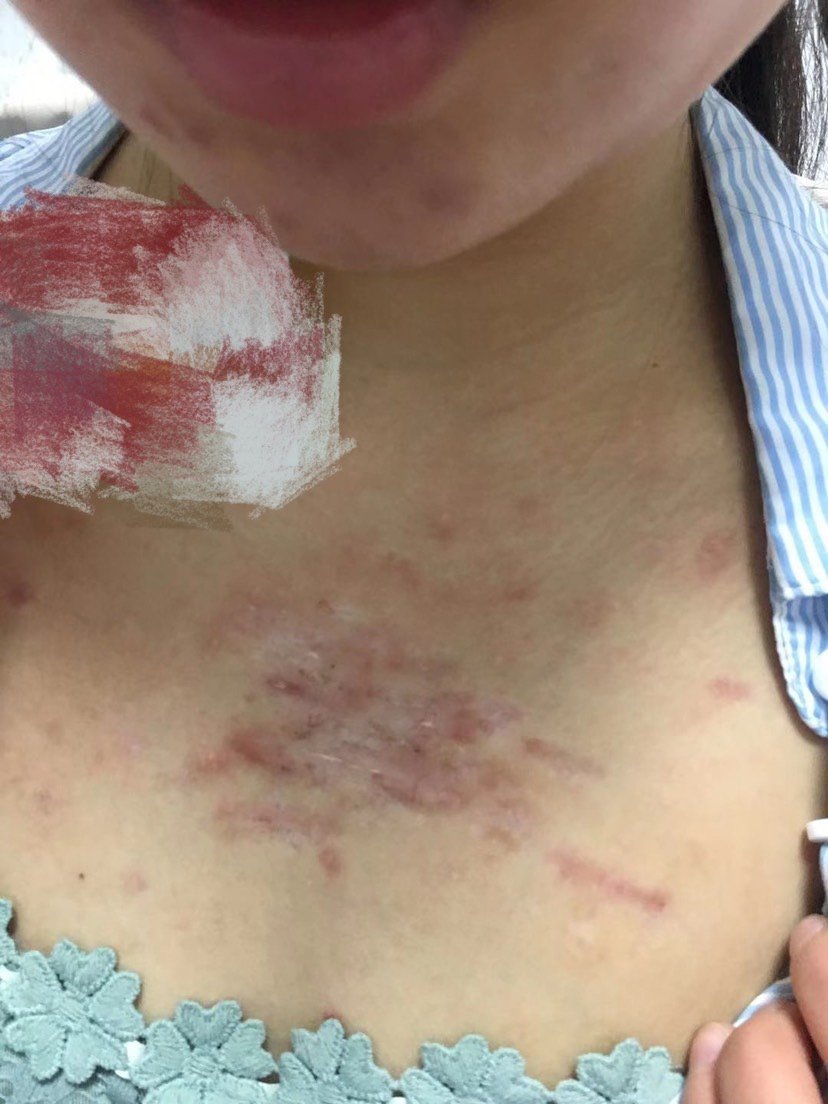 在新氧上了解了几家医院最后到肤康医院在印象里这家治疗皮肤很专业开