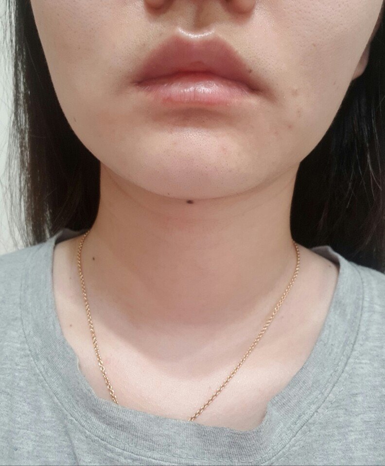 术前我的双下巴真的很明显,脸颊上的肉也很多,肉都要_圈子-新氧美容