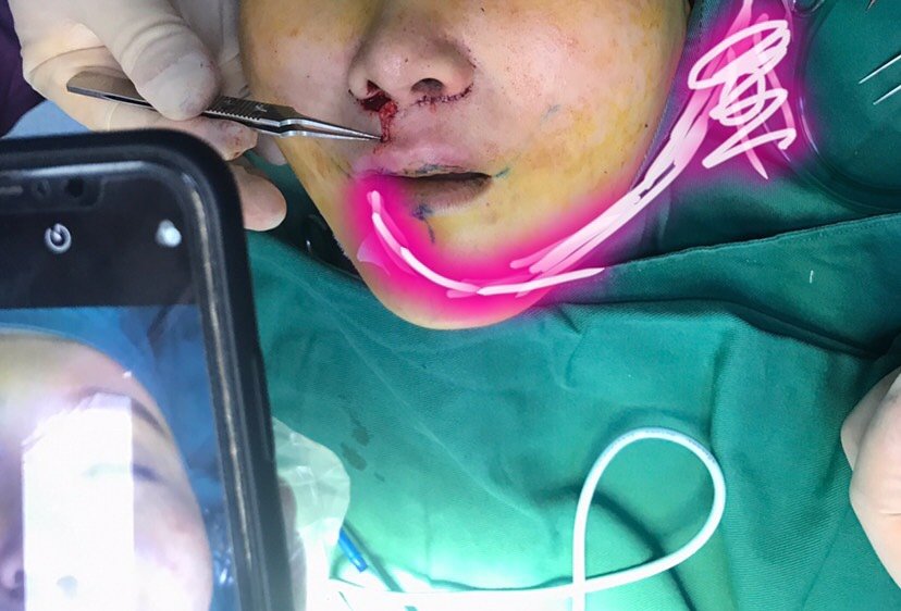 我的人中太长了,而且很浅,整个嘴巴很寡淡,比较显老_圈子-新氧美容