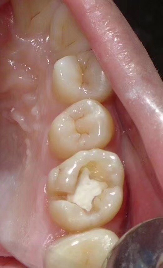 我是每年都要定期洁牙的,这次洁牙发现大牙上有个小黑洞,看起来那么小