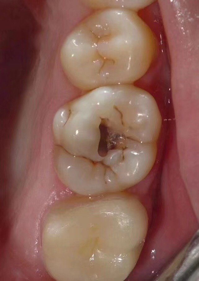 图片蛀牙早期黑点图片 黑洞牙齿上有黑线条是怎么回事大牙黑线烂牙齿