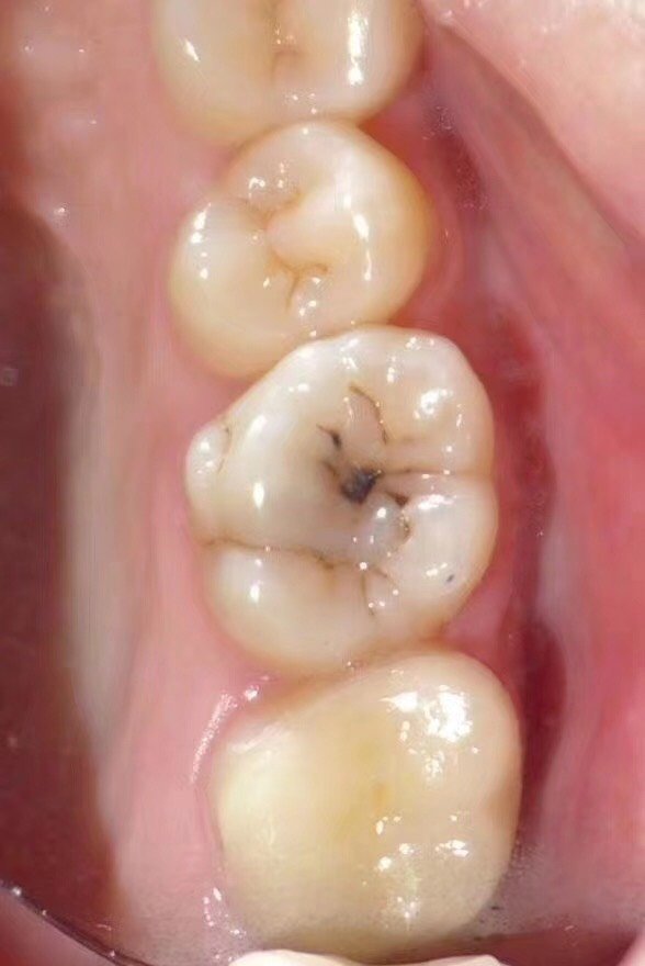 要定期洁牙的,这次洁牙发现大牙上有个小黑洞,看起来那么小的一个黑点
