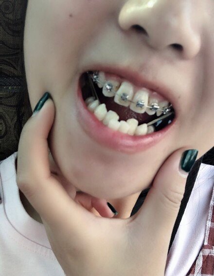 我的问题是两颗门牙兔子牙,牙列不整齐,已经粘上牙的_圈子-新氧美容