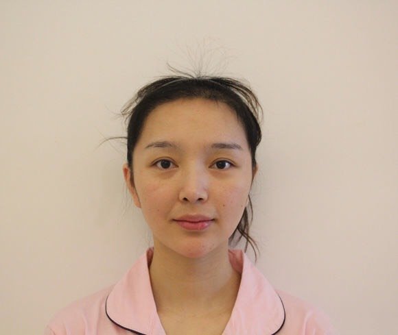 【埋线提升】全脸线雕 艺术面雕 ppdo蛋白线童颜面部提升 促进胶原