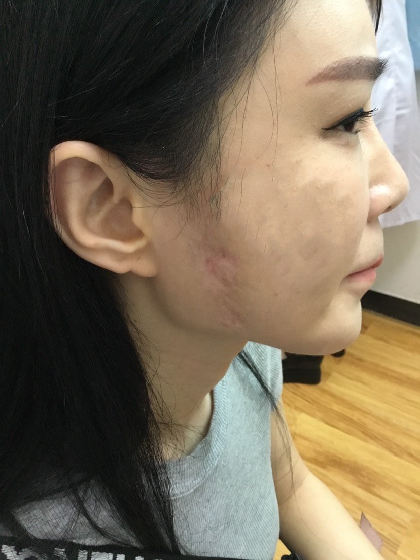 一直对自己的脸上有疤痕觉得很自卑,在新氧上查询和咨
