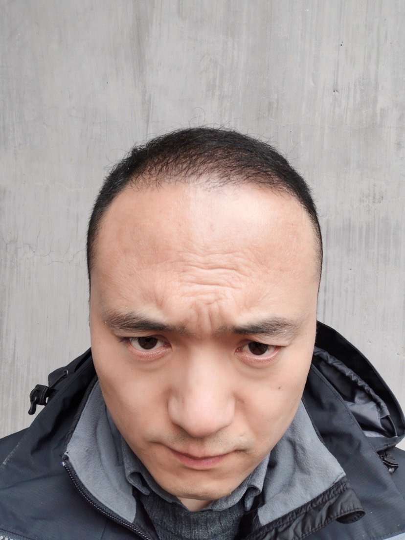 【头顶加密种植】【稀疏加密】浓密自然 增发防脱 方向自然 不伤原生