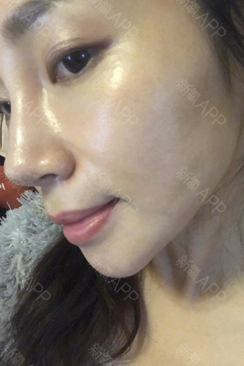 做线雕隆鼻的好处就是完全没有恢复期,第二天就能照常_圈子-新氧美容