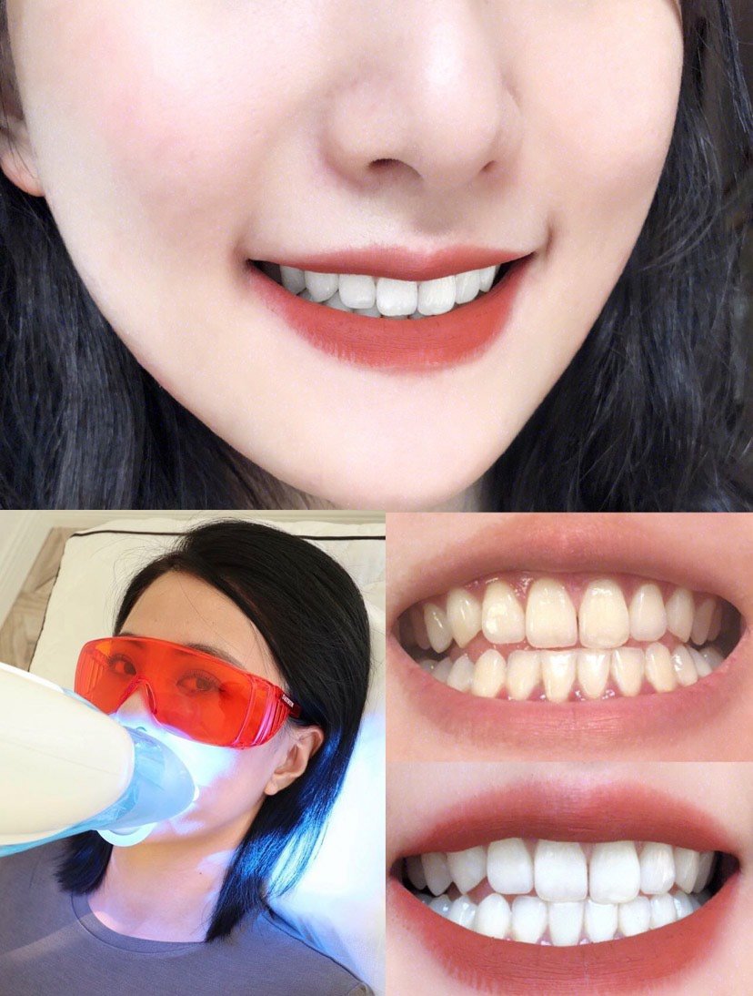 【冷光美白】深层去除牙齿色素 打造明星大白牙,让笑容更自信