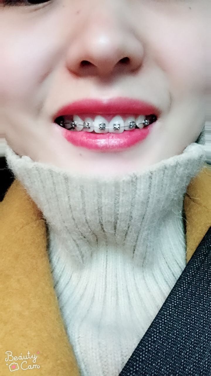 90后老姑娘一枚,牙齿歪七扭八的,非常的丑,而且从_圈子-新氧美容整形