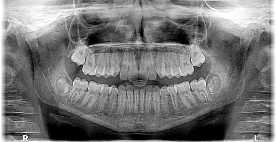 舌骨x线图片图片