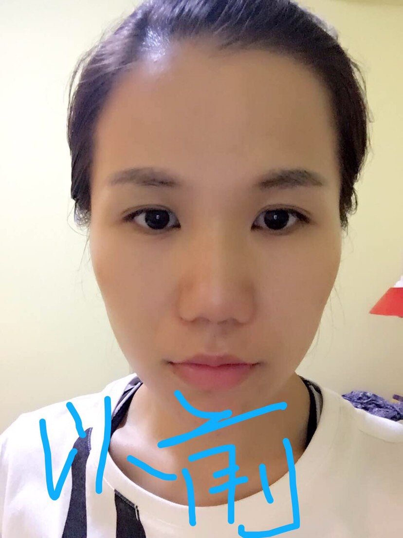 我鼻子不高,鼻头比较大,鼻根也很宽,宽鼻是我第一个_圈子-新氧美容