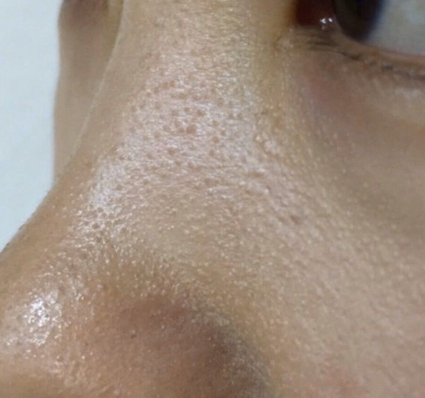 鸡皮肤有医美吗(鸡皮肤能通过医美治好吗) 鸡皮肤有医美吗(鸡皮肤能通过医美治好吗)