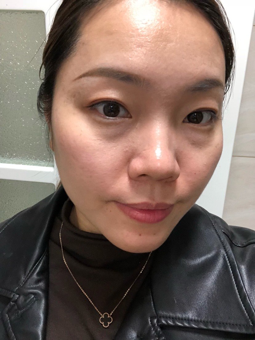 左脸的黄褐斑伴随自己大概七八年了,现在终于解决了,希望不会重新再长