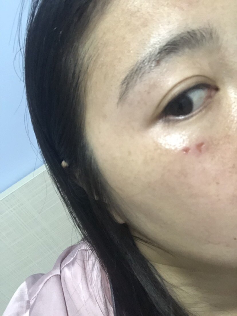 激光点痣给我点了那么大一个坑,本来是很小很小的一颗_圈子-新氧美容
