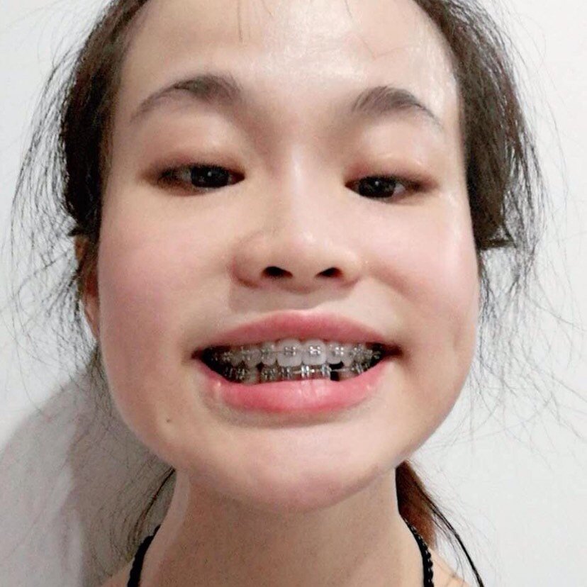 牙齿上很不习惯呢戴久了应该就会舒服一些的吧唉开始我的钢牙妹之旅啦