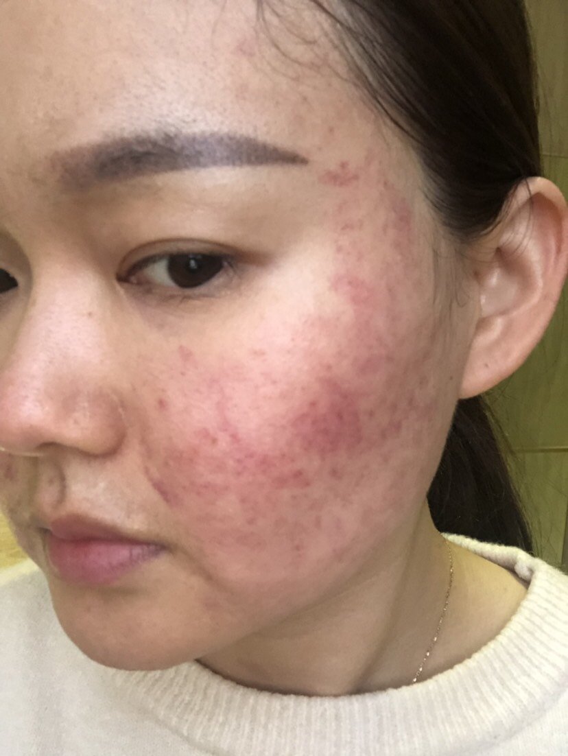 之前做过很多次热拉提都没有这么严重的出痧情况!