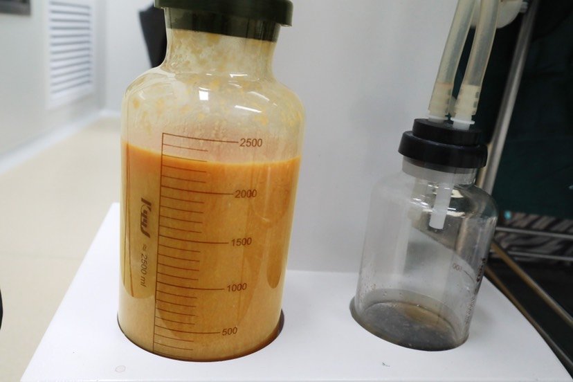 今天去拆线了,也看了自己抽出来的脂肪照片,确实技术_圈子-新氧美容