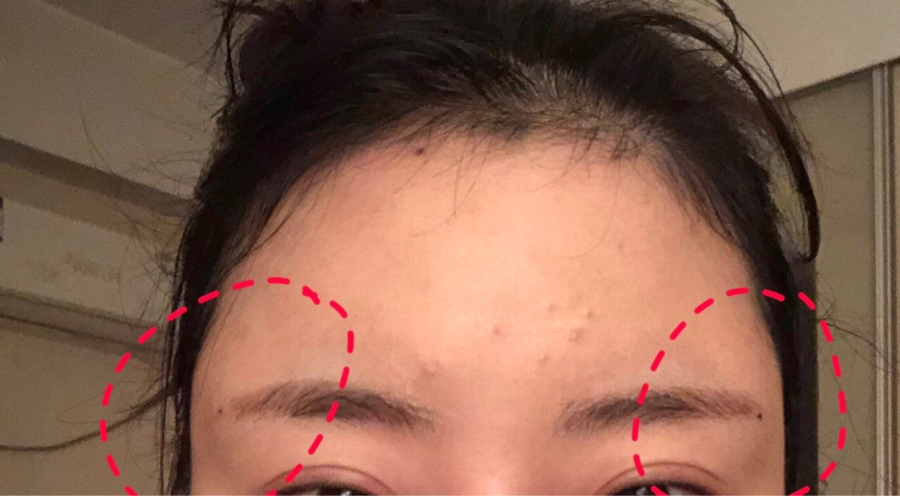 我的太阳穴已经打了一个月了还是肿着我的眉尾两边