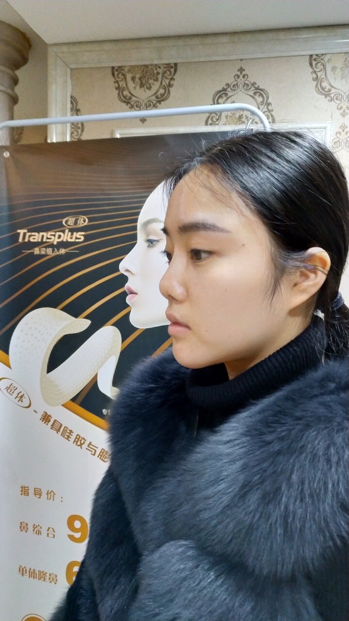 之前隆鼻失败形成包膜挛缩,成了朝天鼻,真的悔不当初_圈子-新氧美容