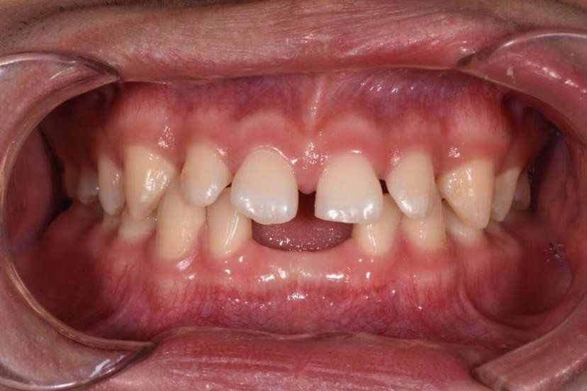 矫正牙齿真的给我变帅啦,兜兜齿改善了好多,回到了正常的形态,太开心