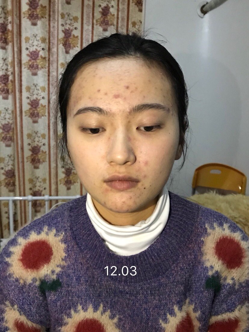 无美颜素颜照片,因为多囊长痘痘所以别喷我,我玻璃心_圈子-新氧美容