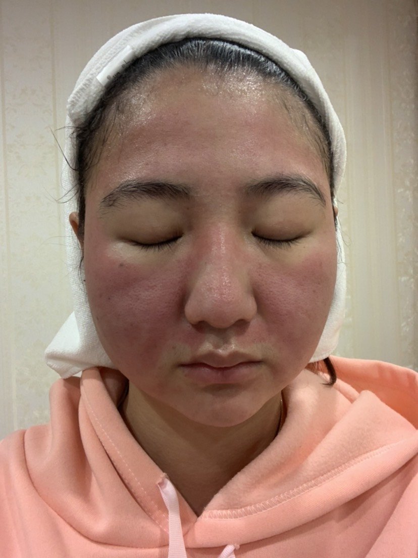 刚做完脸部发红发烫麻药过后还有点痛