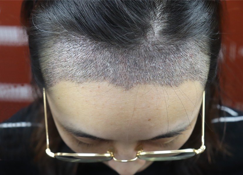 现在已经慢慢在结痂了,种的头发开始长出了小发芽,密密麻麻的有些扎手