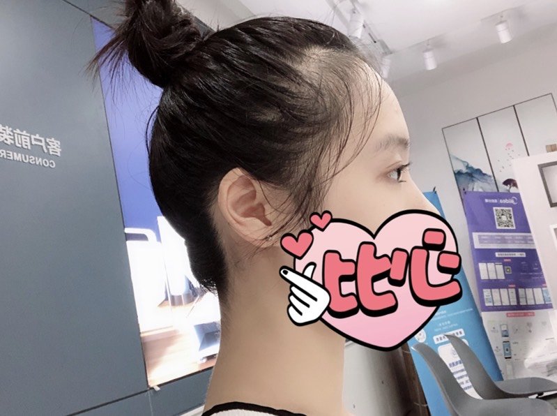 从侧面看我的发际线不仅是高,还是少,额角头发稀疏,_圈子-新氧美容