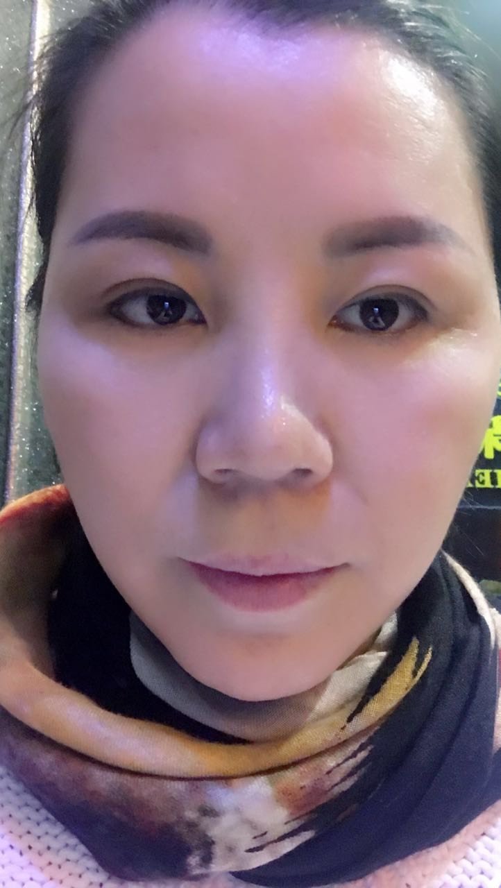 我十年前做的埋线双眼皮现在年纪大一些就有点松弛了弧度也不流畅这次