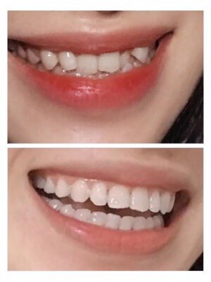 内凹的门牙和虎牙,刚带上金属做的托槽是有酸酸的和凸_圈子-新氧美容