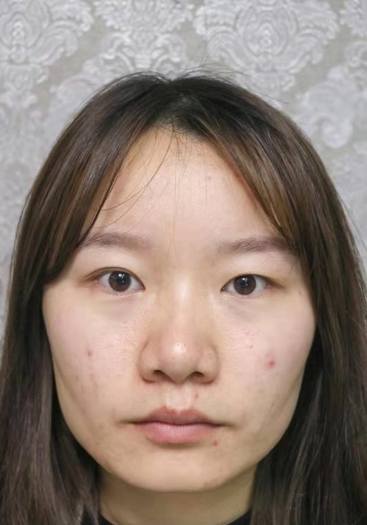 因为单双眼整个眼睛都显得很无神萎靡不振的感觉这些年咨询了很多整形