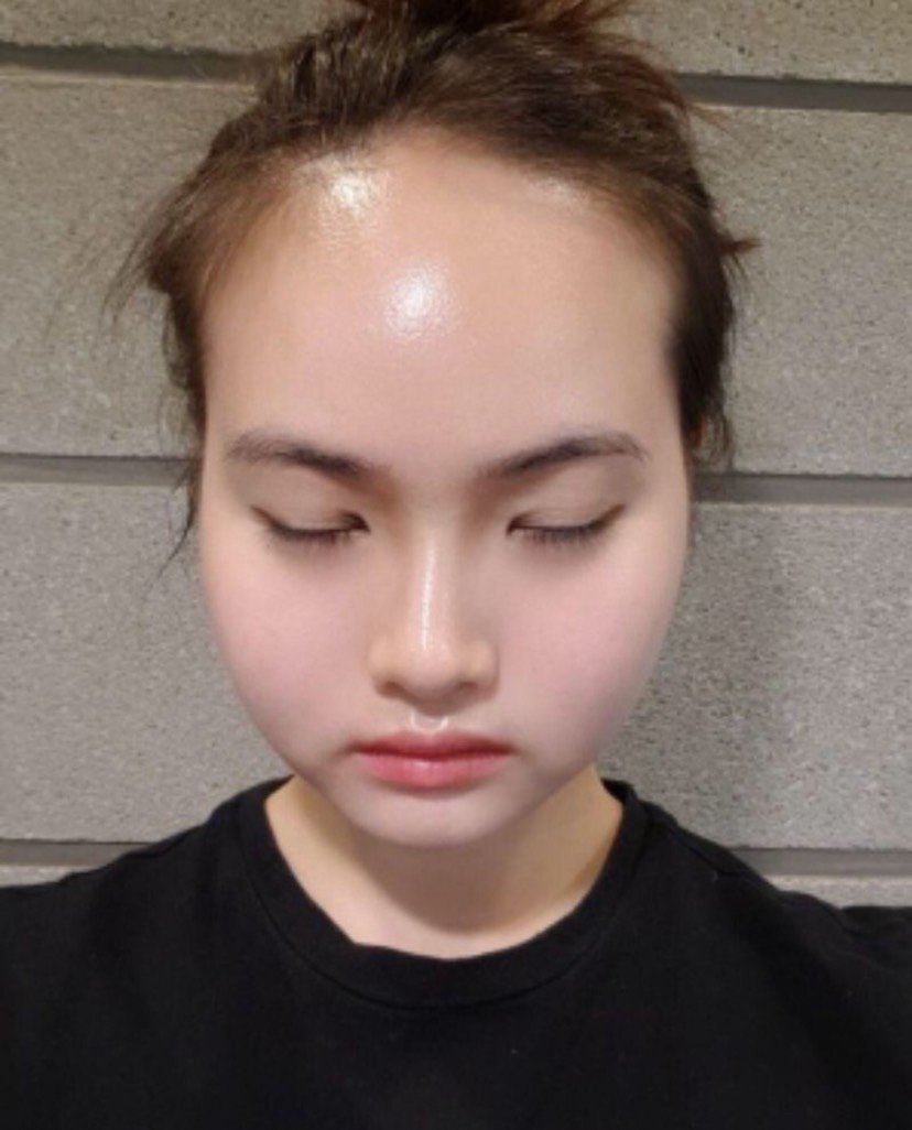 好难啊,终于找到了能做额头缩小的地方,之前误入植发_圈子-新氧美容