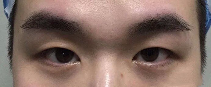 术前我的眼睛无神,单眼皮,黑眼珠暴露度较少,左较右多,左眼上睑有轻微