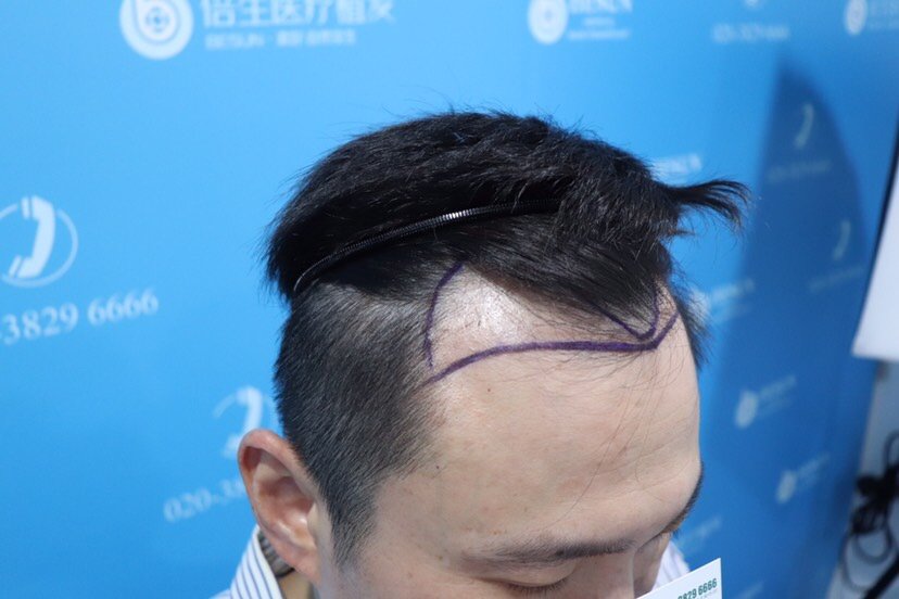 【种植发际线】【植发1000单位】7月特惠,案例招募,全国连锁.