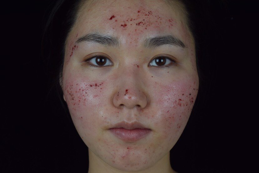 也不知道是不是痘痘天生爱我这张脸,让游走在美女边缘的我好伤心,总是