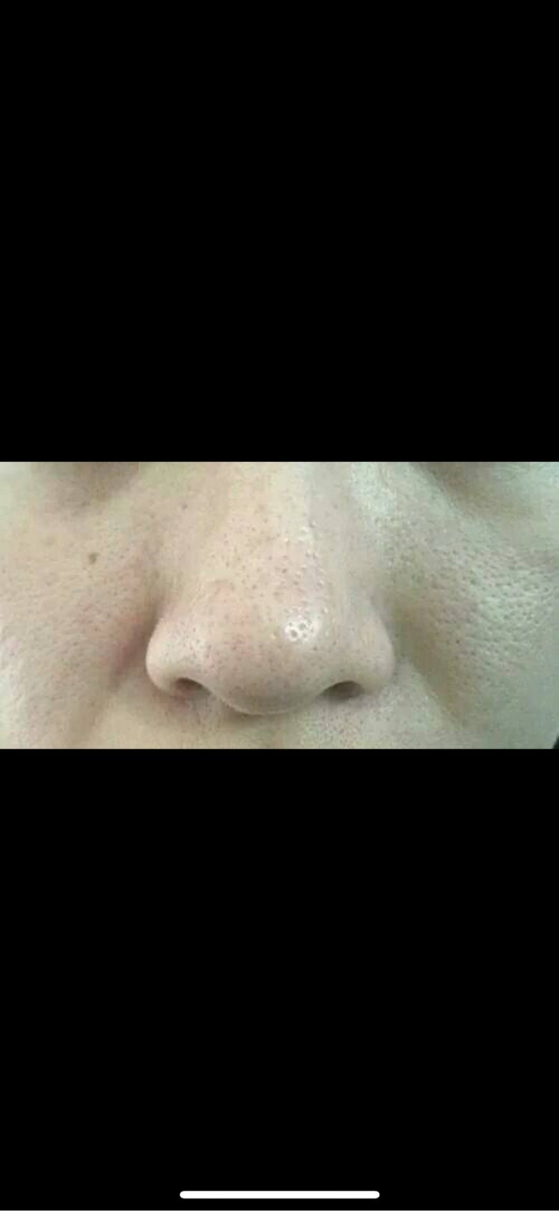毛孔里拔出黑色硬刺毛囊长黑色突出的东西毛孔里有黑色的细毛差皮肤