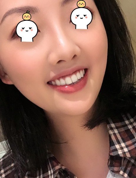 好神奇贴完牙齿整齐了而且白的让我更加爱笑了
