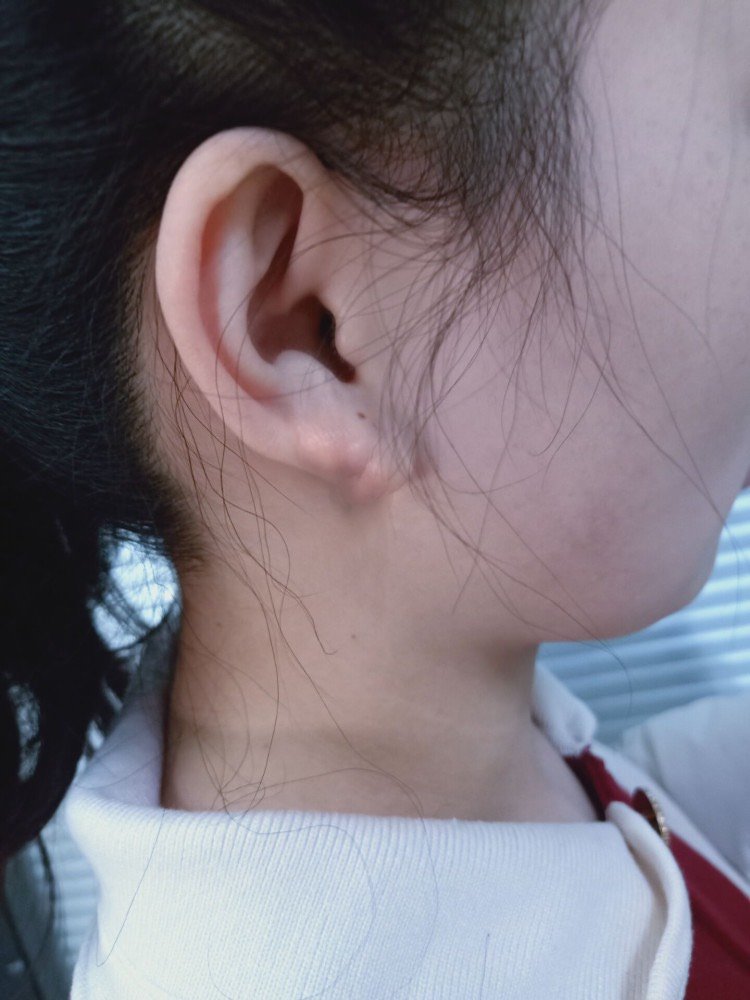 打耳钉之后长的疙瘩,一开始有点感染,流水流脓得有半_圈子-新氧美容