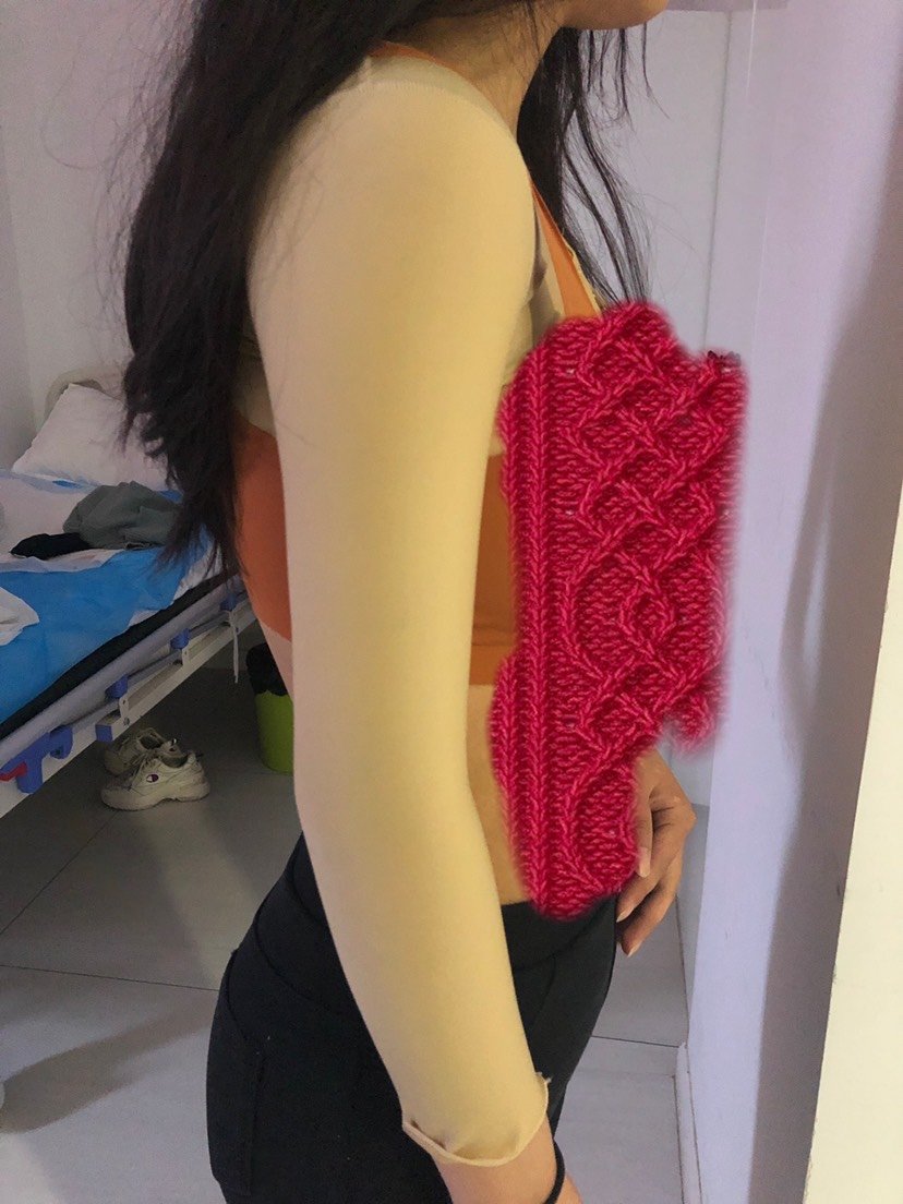 【吸脂】手臂 ,【手臂抽脂】去除拜拜肉,蝴蝶袖,还你紧致纤细胳膊, 原