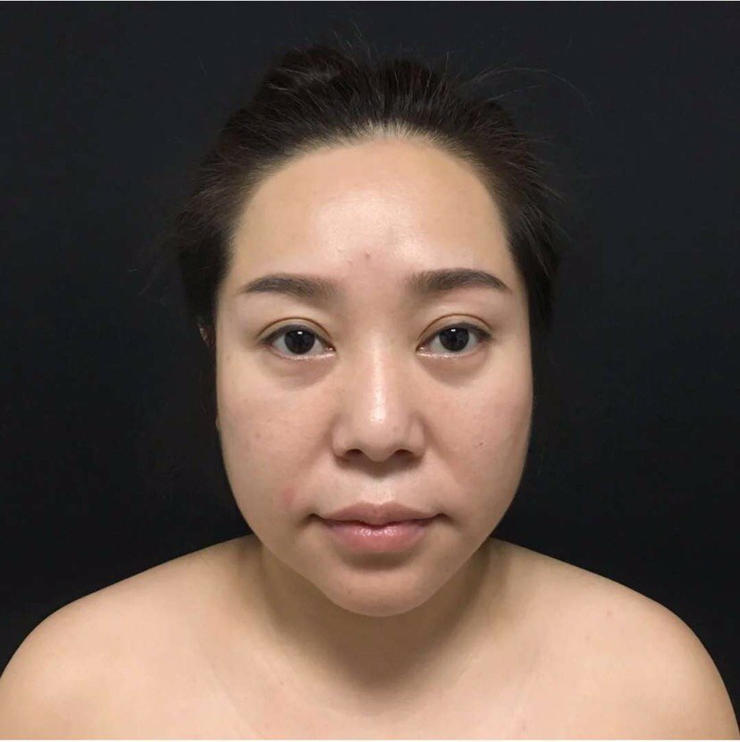 想想自己以前顶着一张干瘪的脸,真的是苦恼,现在在曹_圈子-新氧美容