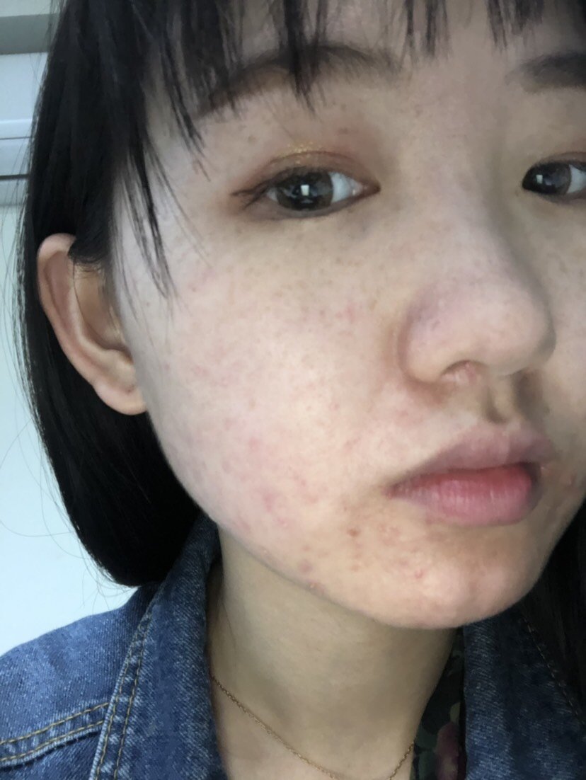 做了王者激光祛斑,做完两周都有反黑结痂,掉落以后斑_圈子-新氧美容