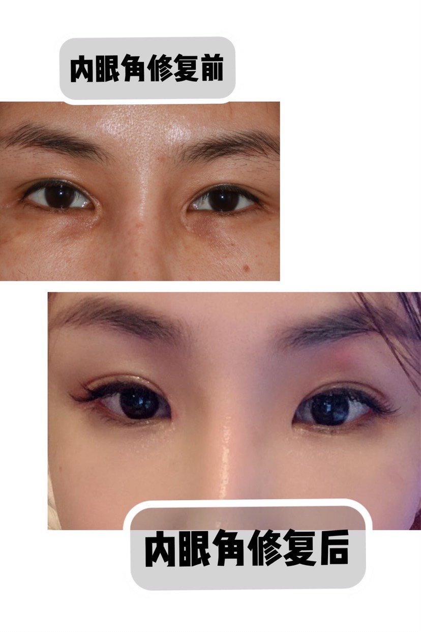 内眼角修复三个多月啦,恢复的基本差不多了